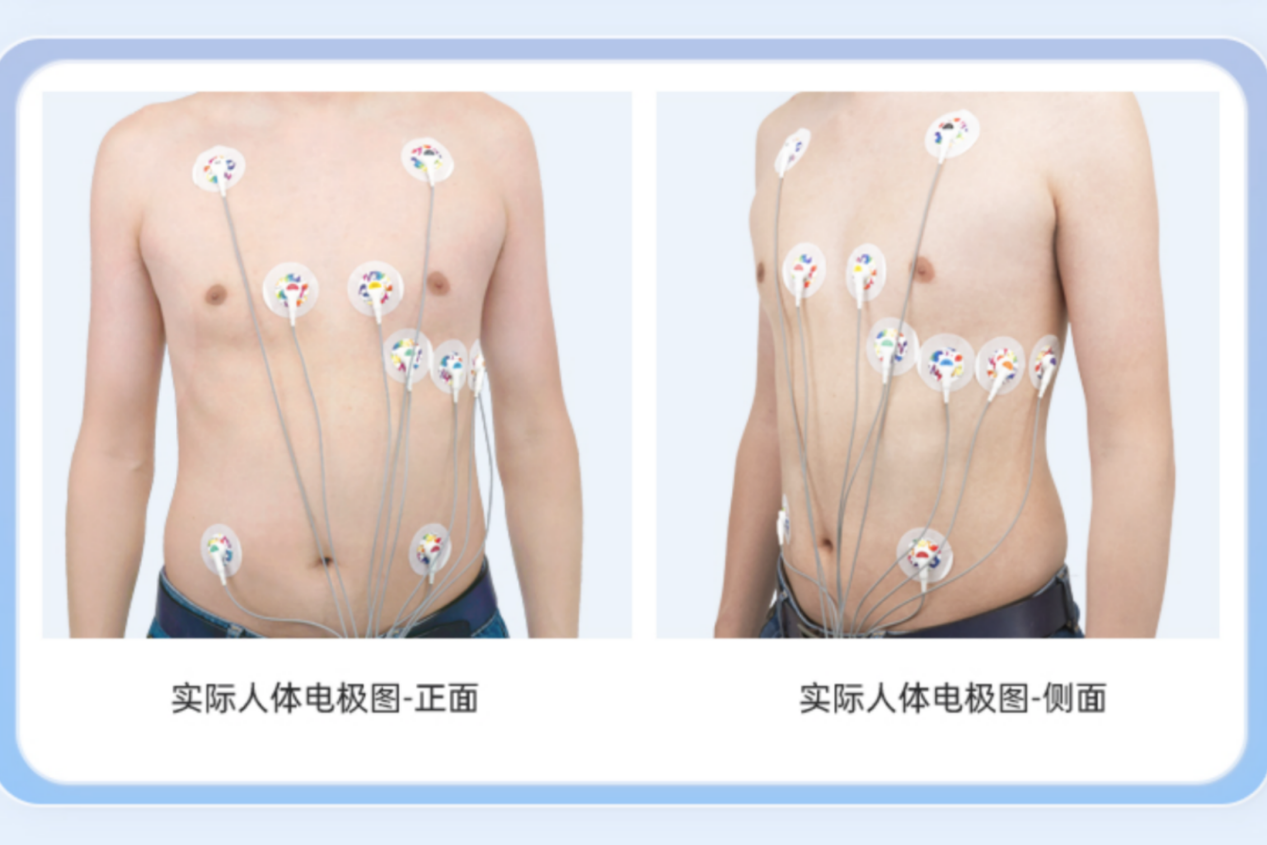 24小时心电图佩戴图